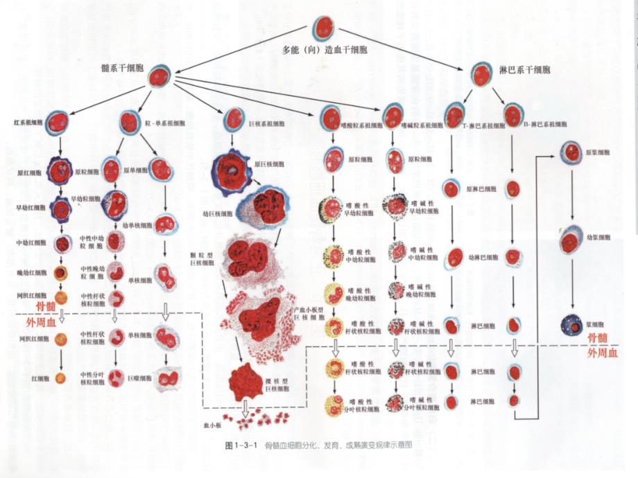 儿科学课件：10-白血病_第4页