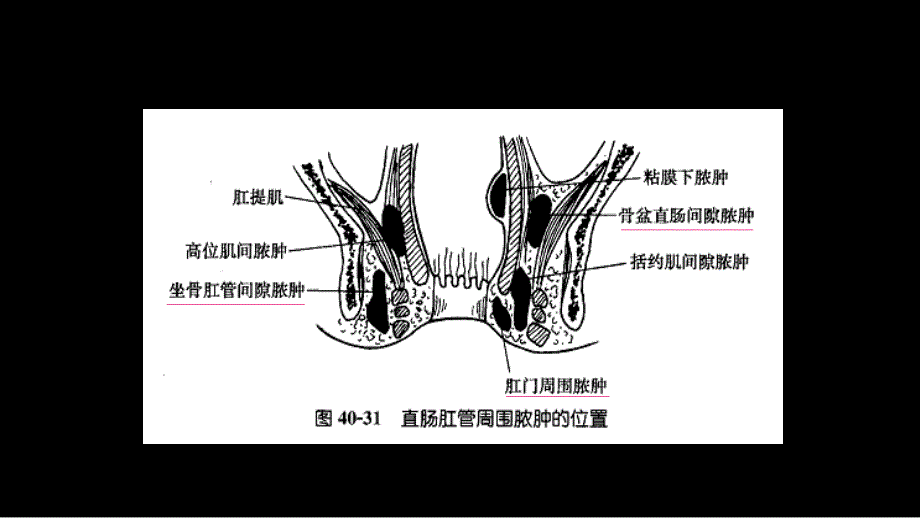 直肠肛管周围脓肿、肛瘘、结肠癌_第2页