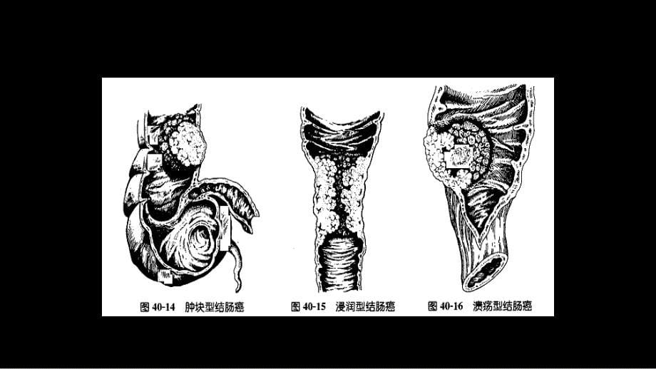 直肠肛管周围脓肿、肛瘘、结肠癌_第5页