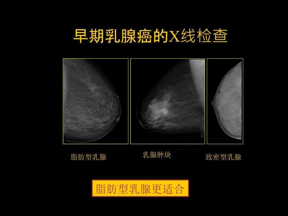 乳腺癌早期影像检查_第5页