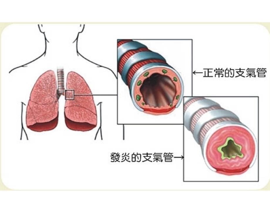 急性支气管炎护理ppt课件_第5页