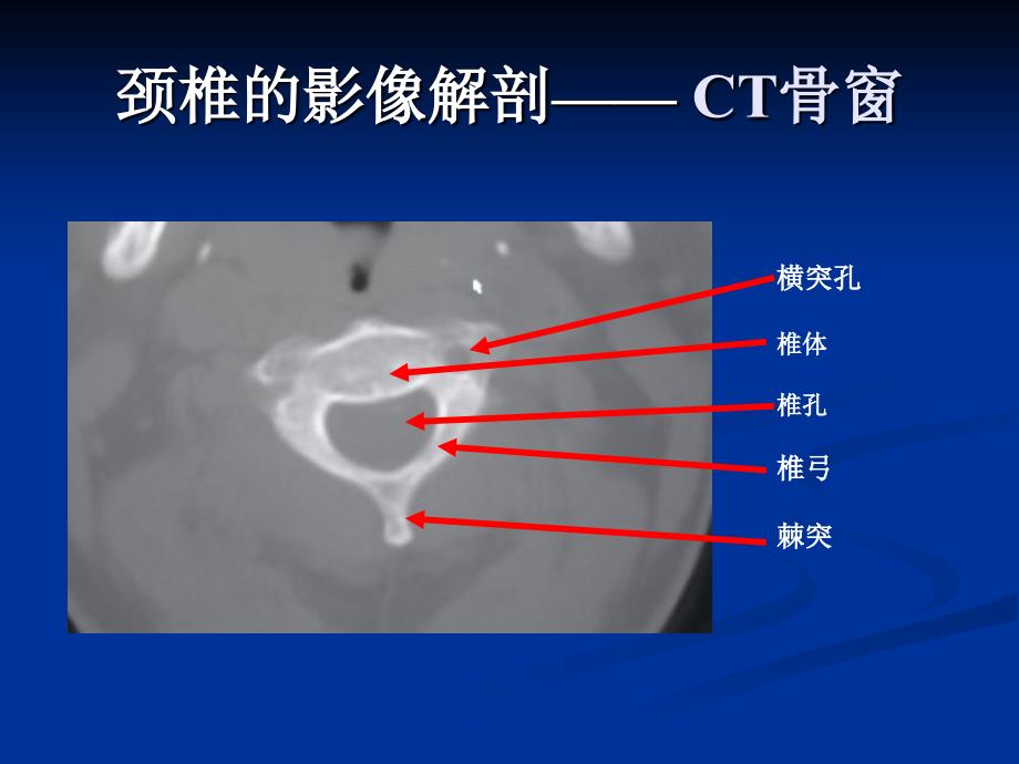 颈腰椎退行性疾病的影像学表现_第4页