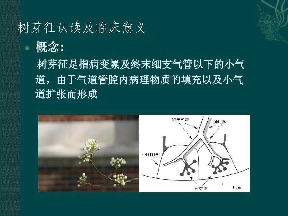 树芽征认读及临床意义.ppt_第2页