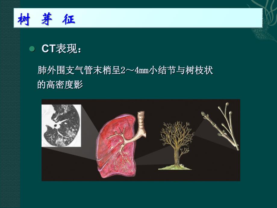 树芽征认读及临床意义.ppt_第3页