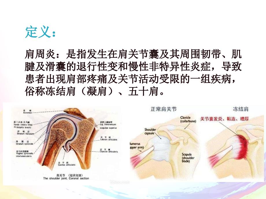 肩周炎的治疗及护理_第2页