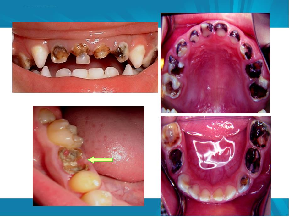 儿童口腔保健及不良习惯ppt课件_第3页
