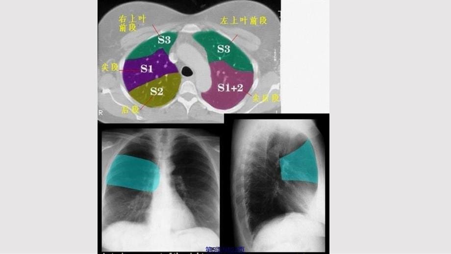 CT正常彩色解剖图谱肺段解剖实用教案_第5页