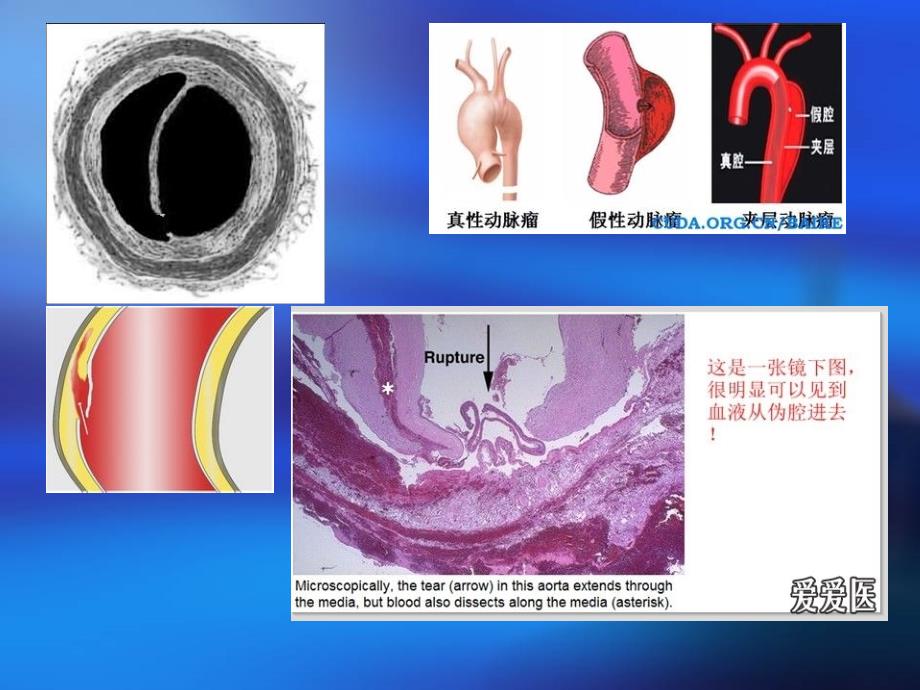 胸主动脉夹层.ppt_第4页