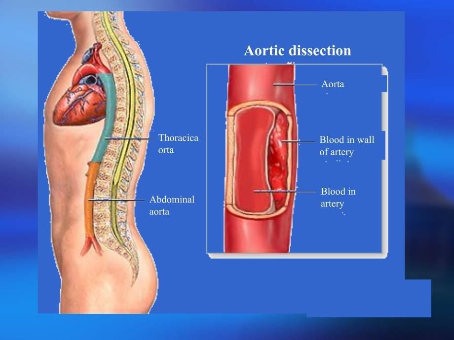胸主动脉夹层.ppt_第5页