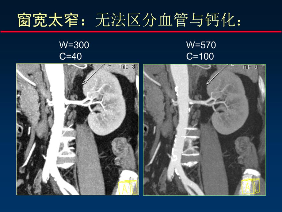 泌尿系统ct检查的要领下_第3页