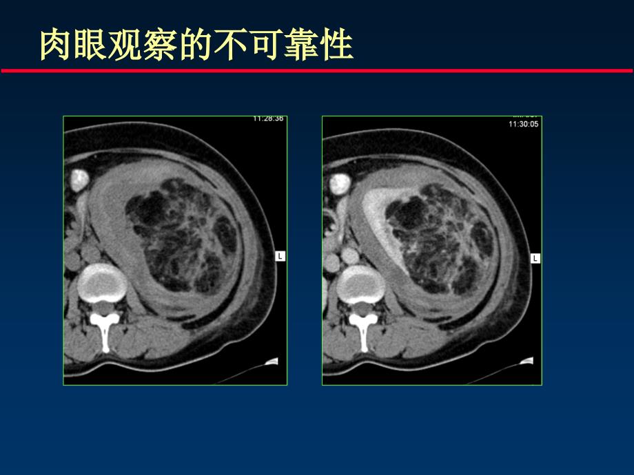 泌尿系统ct检查的要领下_第4页