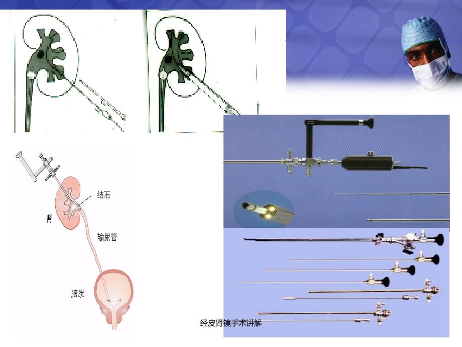 经皮肾镜手术讲解_第3页