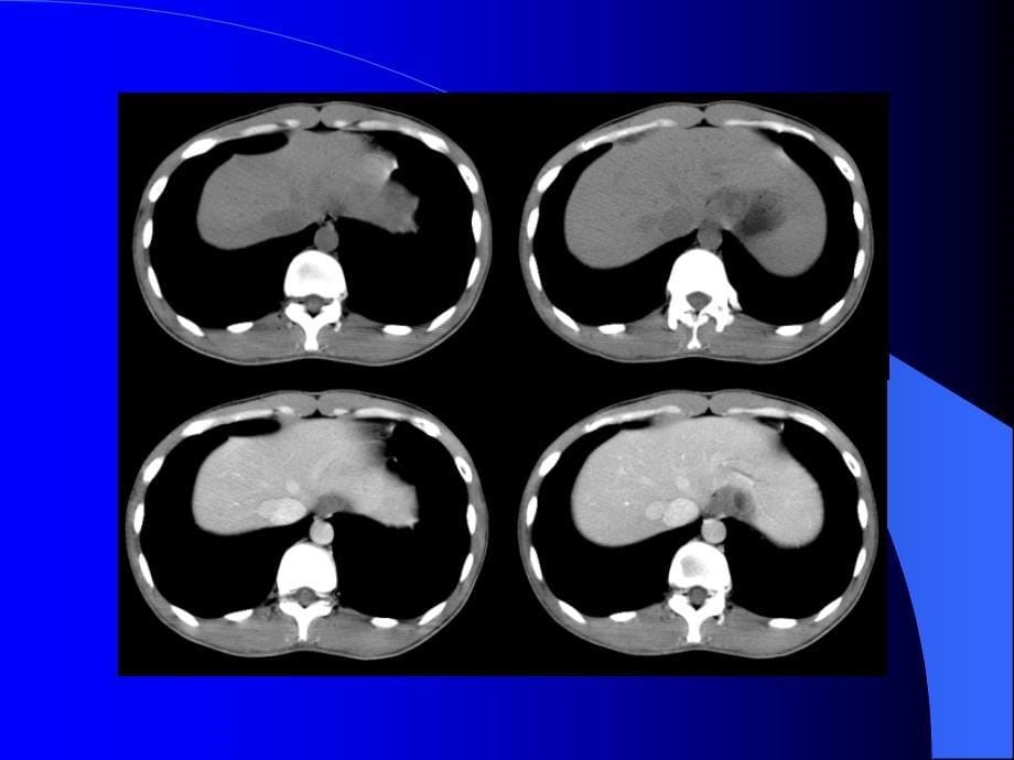 上腹部CTCT检查技术及诊断_第5页