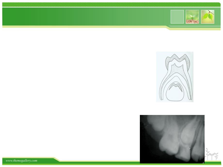 乳牙的根管治疗37915_第4页