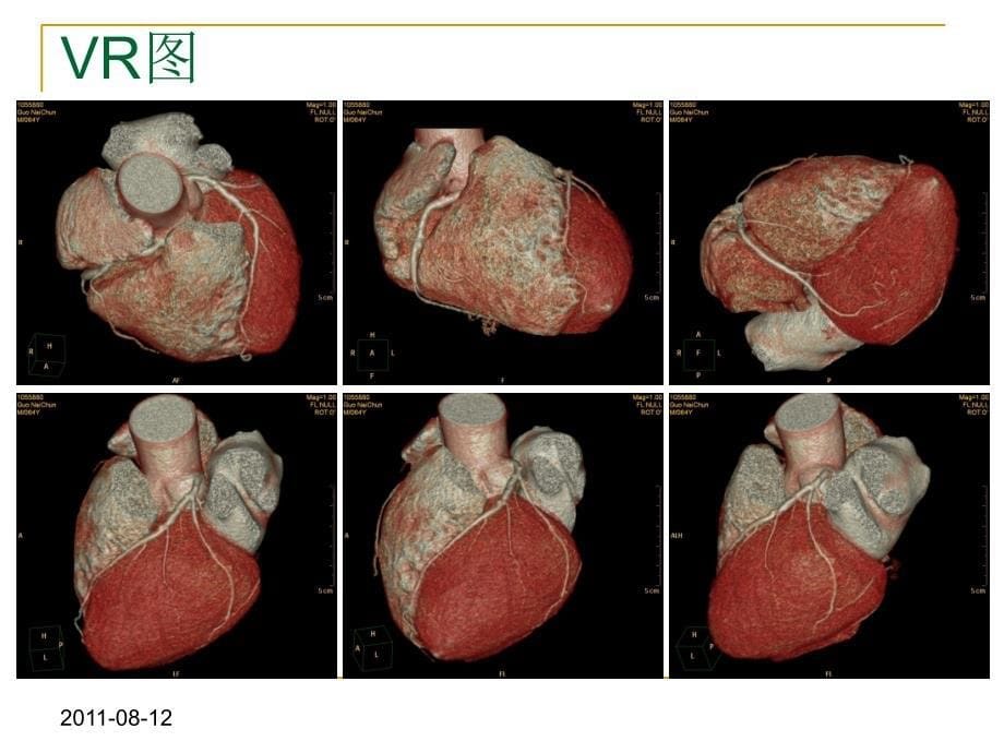 冠状动脉CTA图像判读_第5页