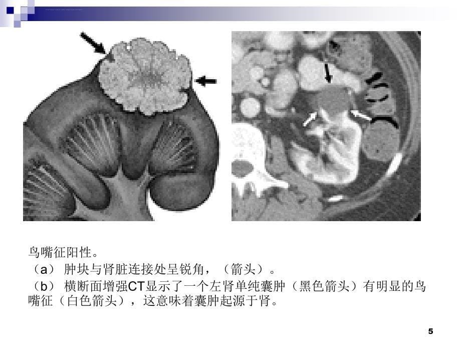 腹膜后脂肪性病变的影像学特征定位及鉴别诊断ppt课件_第5页