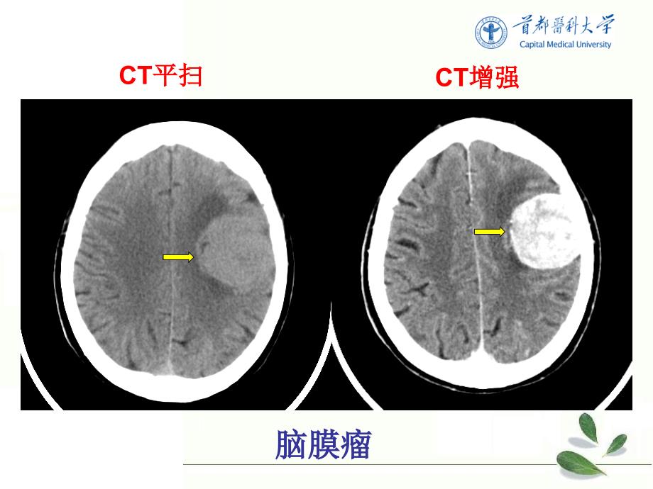 《医学影像技术学》教学课件：中枢神经系统-6_第3页