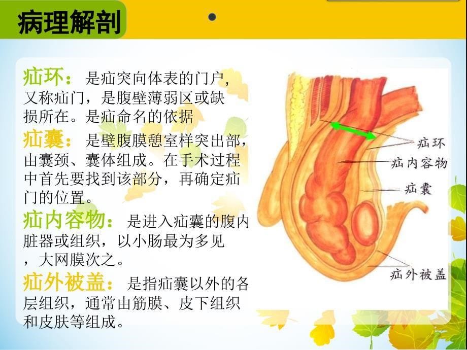 腹股沟疝手术配合.ppt_第5页