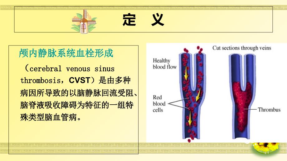 一例颅内静脉窦血栓形成病人的护理_第2页