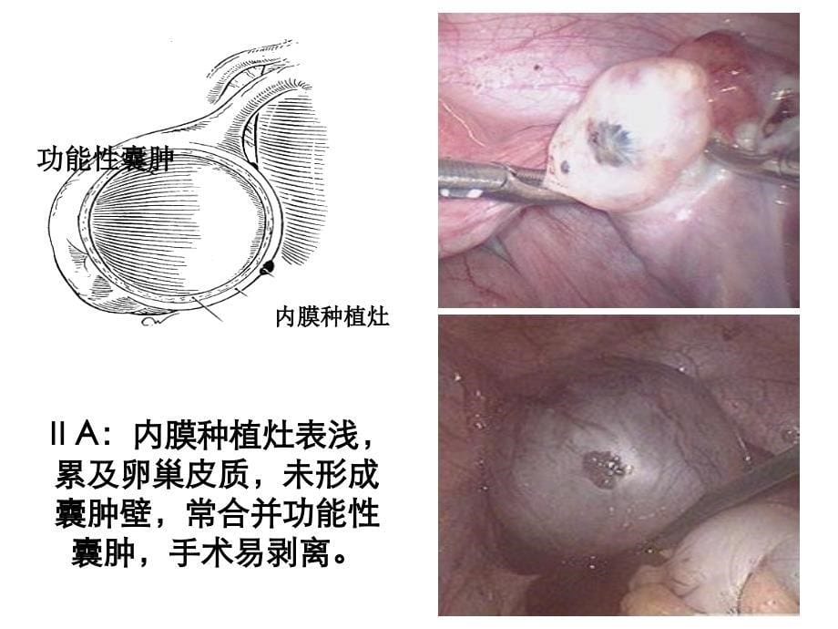 卵巢子宫内膜异位症_第5页