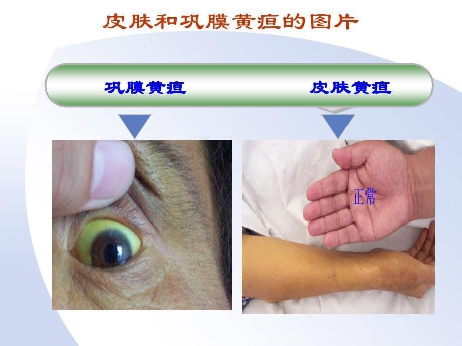 健康评估黄疸教学课件_第5页