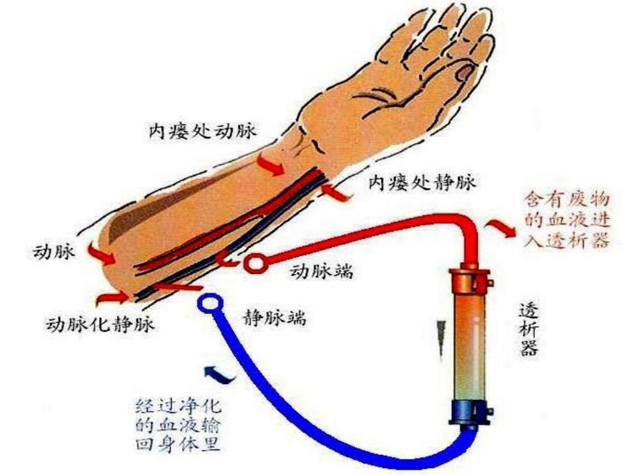 动静脉内瘘的围手术期护理ppt课件_第4页