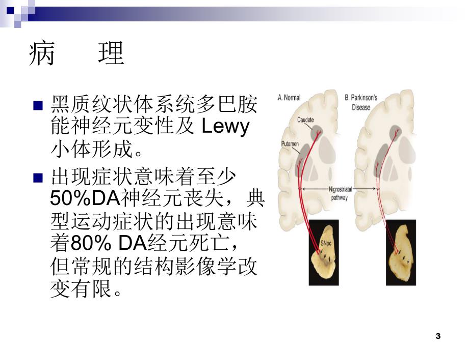 帕金森病的神经影像学PPT课件_第3页