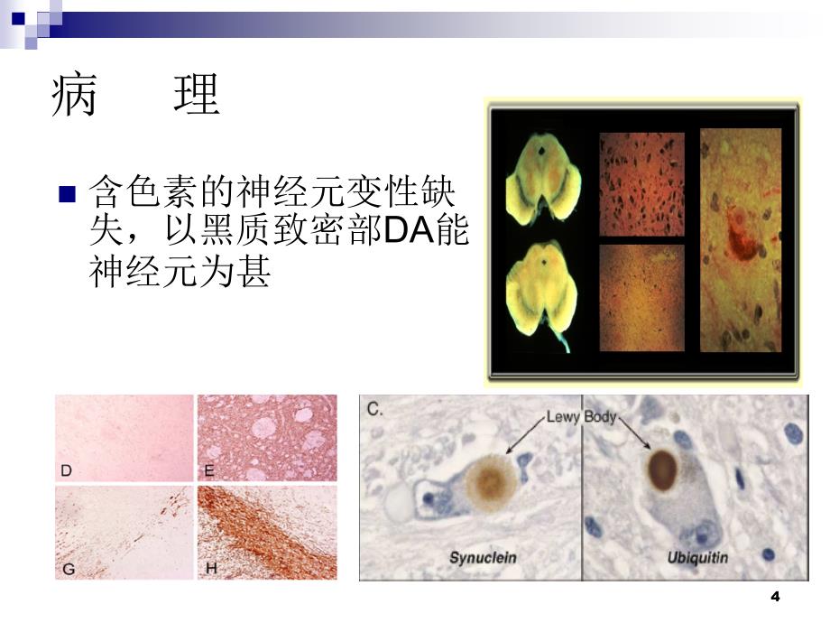 帕金森病的神经影像学PPT课件_第4页