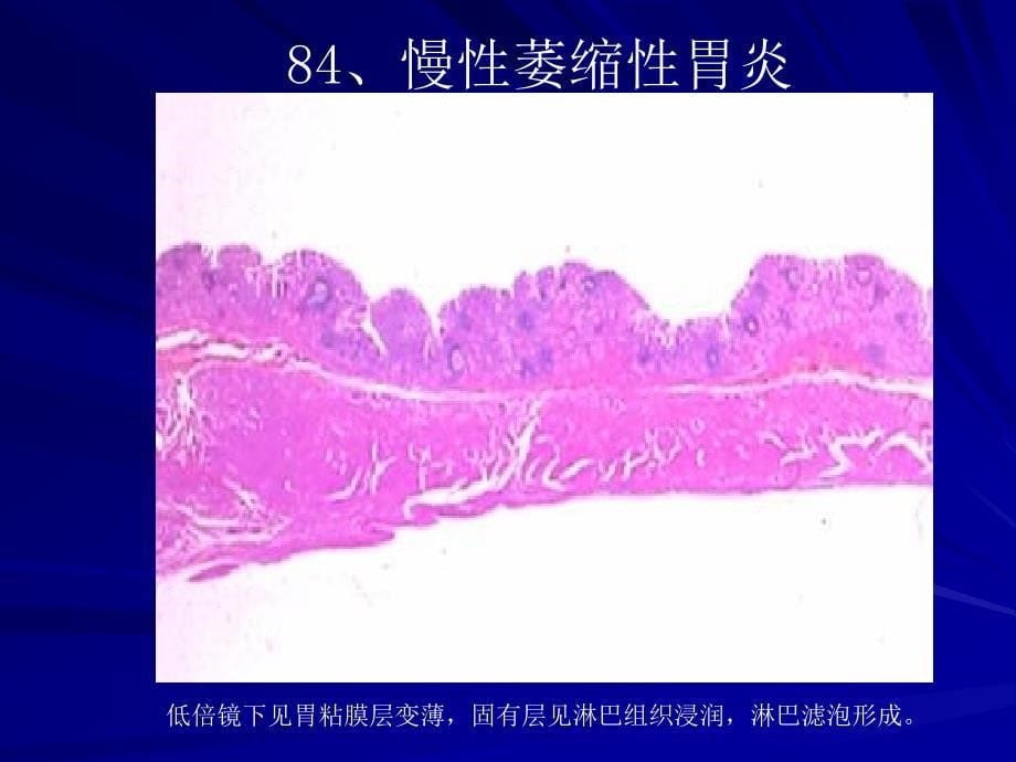 病理学实验课件：实验七 消 化 系 统_第5页