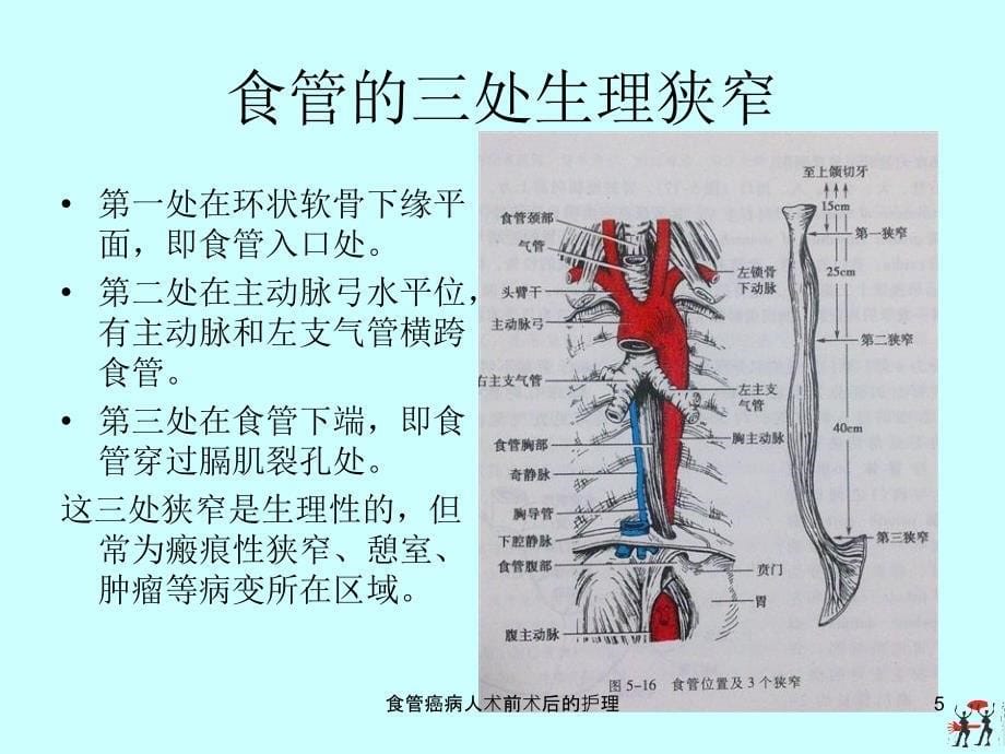 食管癌病人术前术后的护理课件_第5页