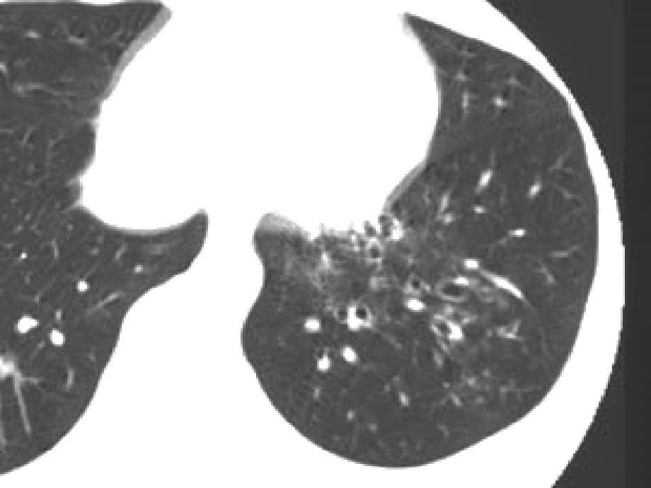 胸部疾病的CT诊断_第5页