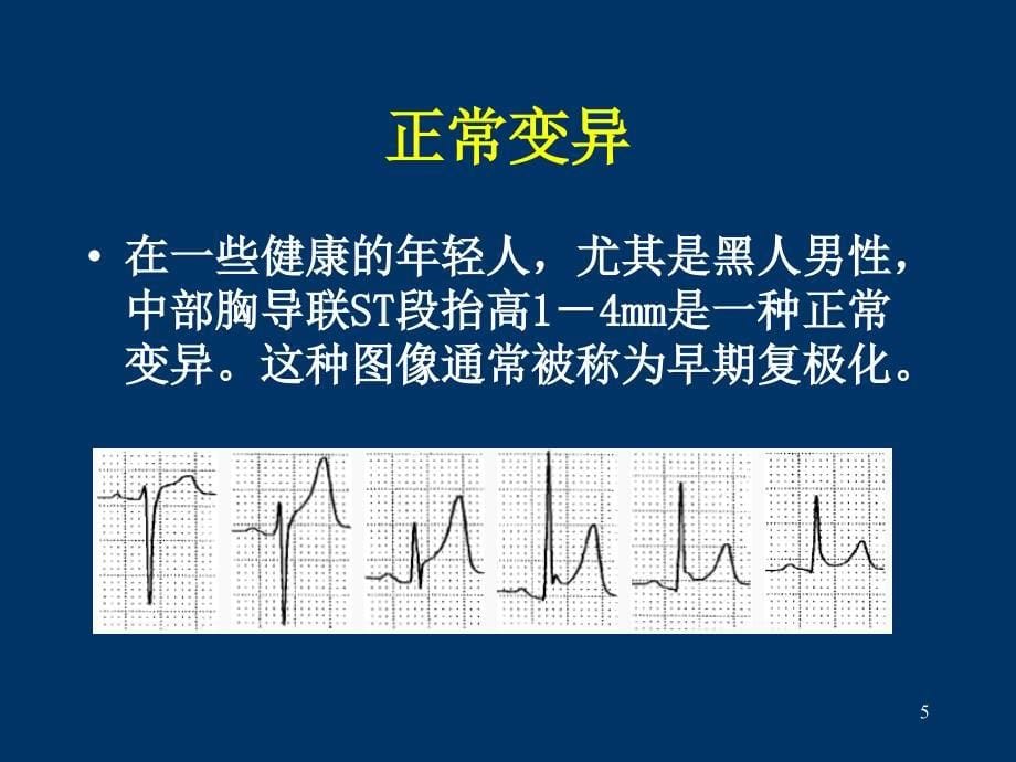 ST段抬高的鉴别诊断APPT参考幻灯片_第5页