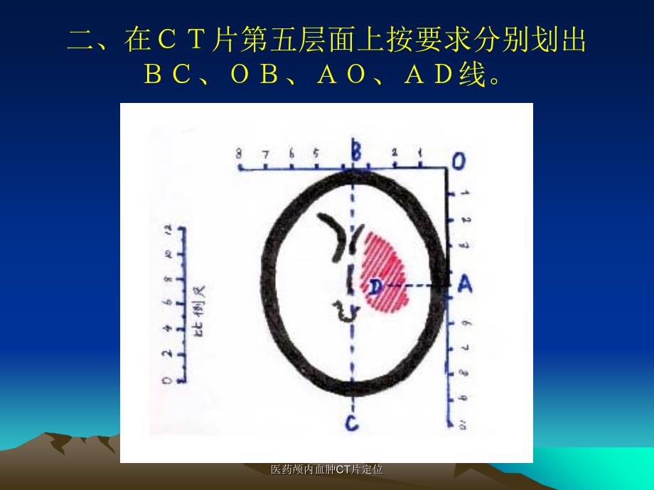 医药颅内血肿CT片定位课件_第3页