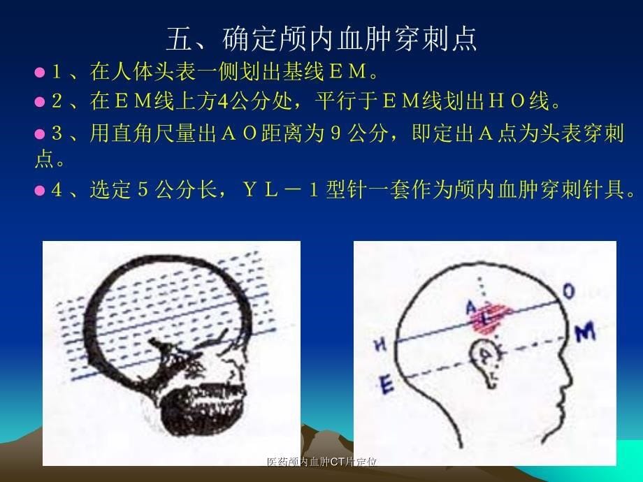 医药颅内血肿CT片定位课件_第5页