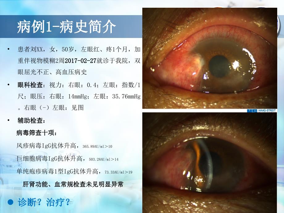 优质医学角膜内皮炎的诊断与治疗体会_第2页