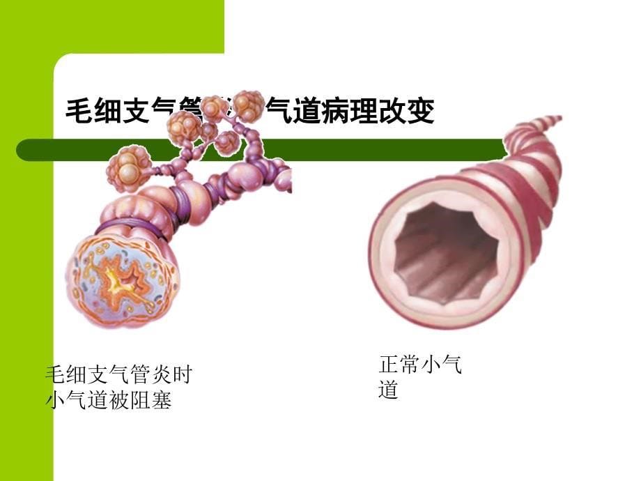 小儿毛细支气管炎1_第5页