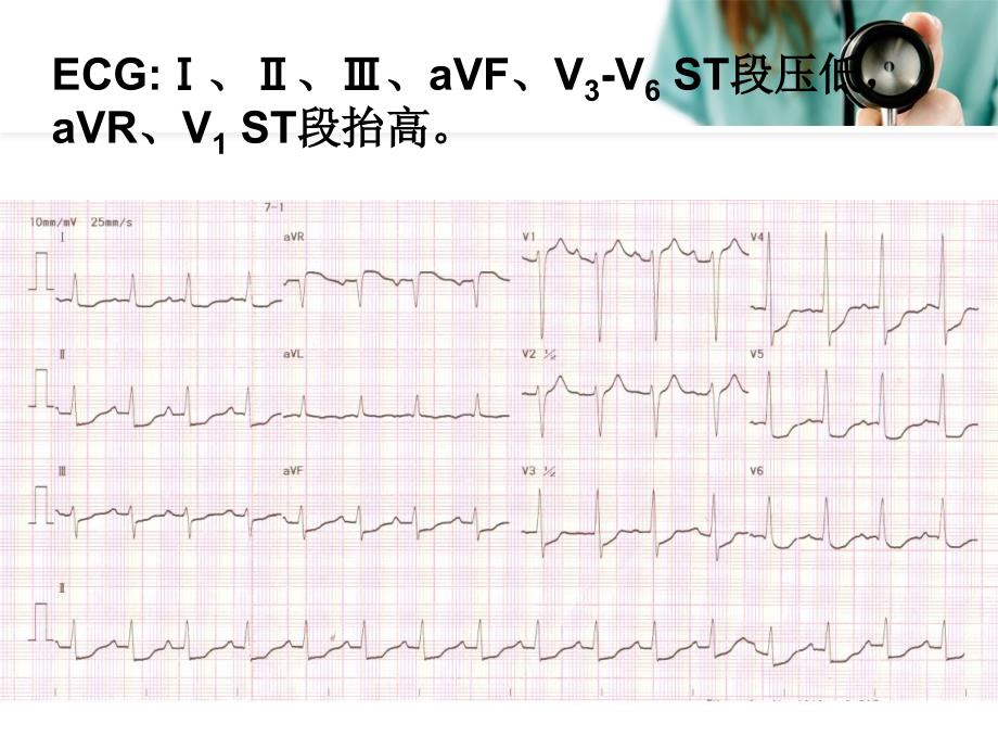 重视左主干病变心电图价值.ppt_第4页