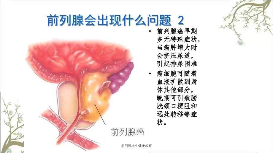 前列腺增生健康教育_第5页