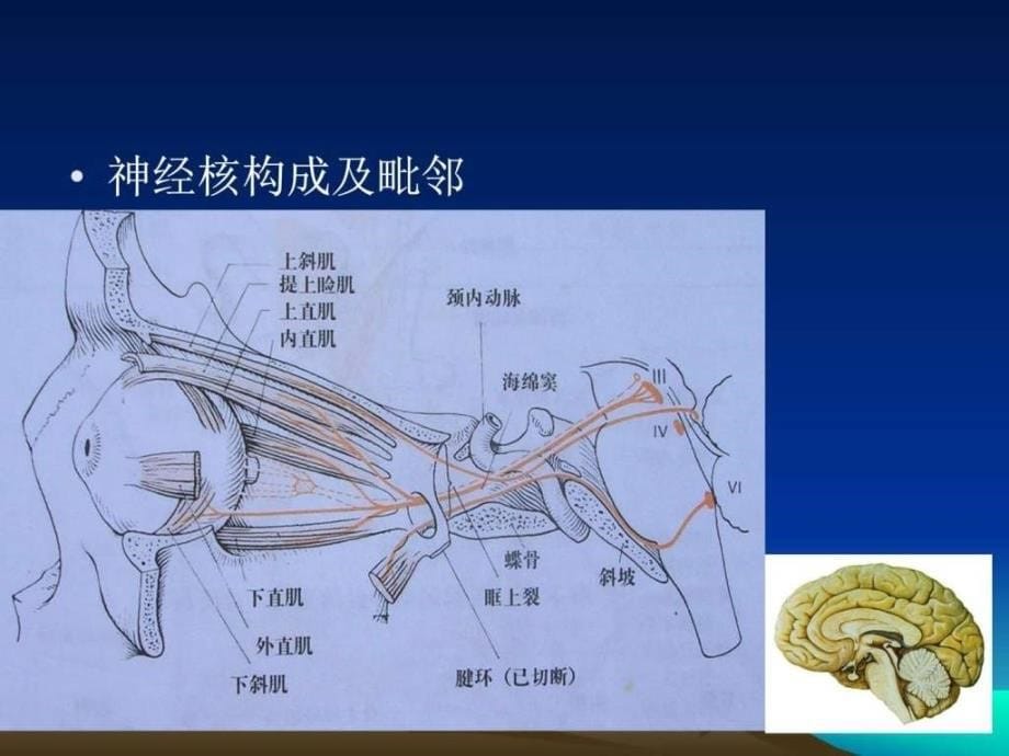 痛性眼肌麻痹临床医学医药卫生专业资料.ppt_第5页