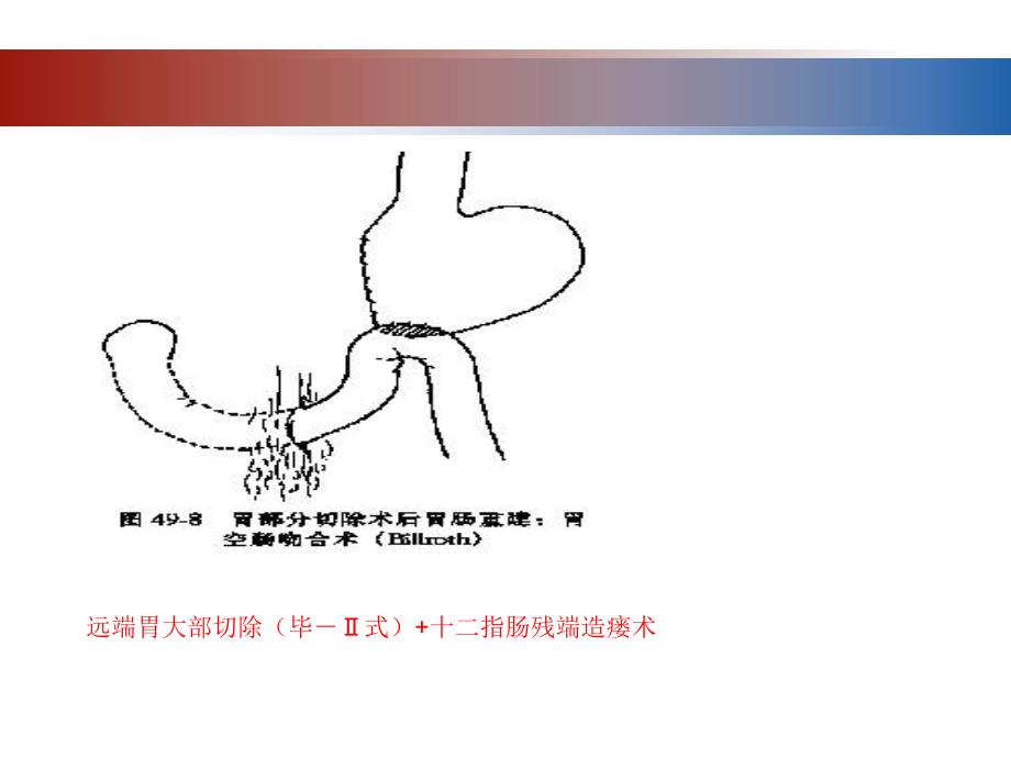 肠道手术后肠瘘的发生与对策_第3页