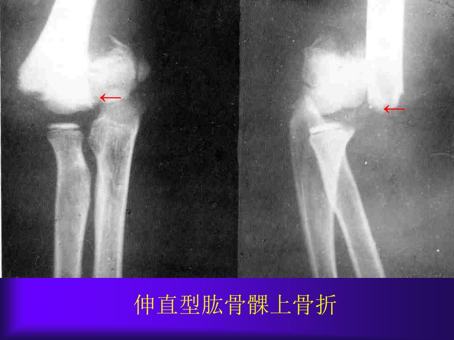 常见四肢骨折课件_第4页