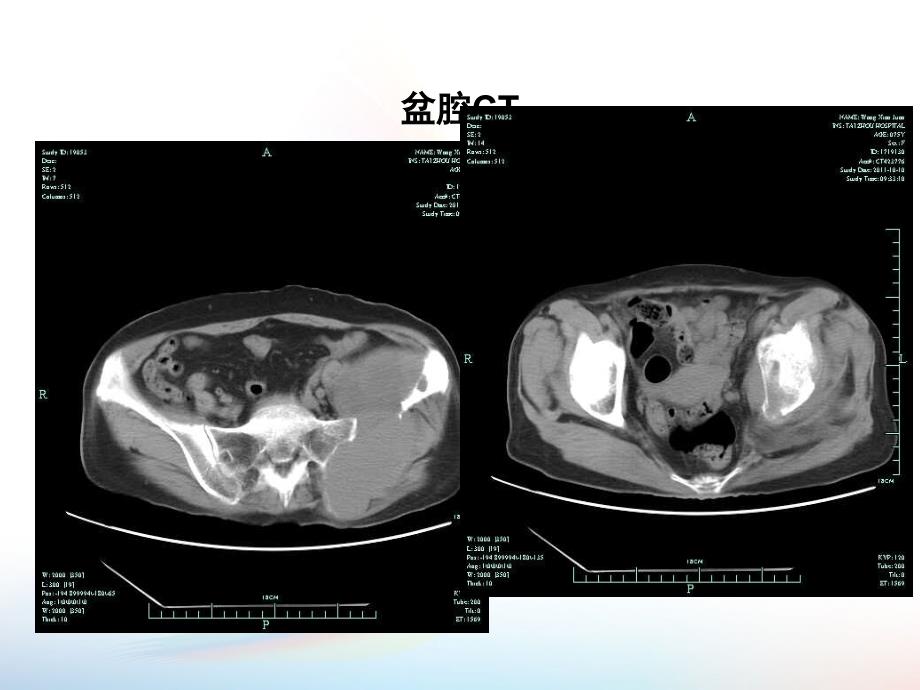 GPM癌痛病例_第3页