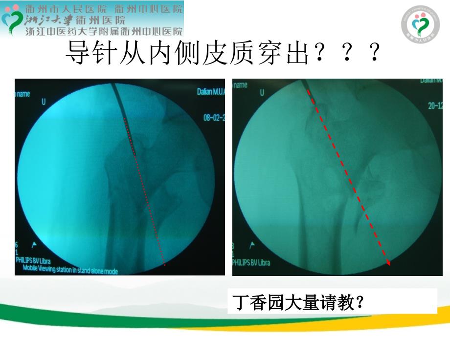 PFNA治疗股骨转子间骨折牵引床手术体位技巧_第3页