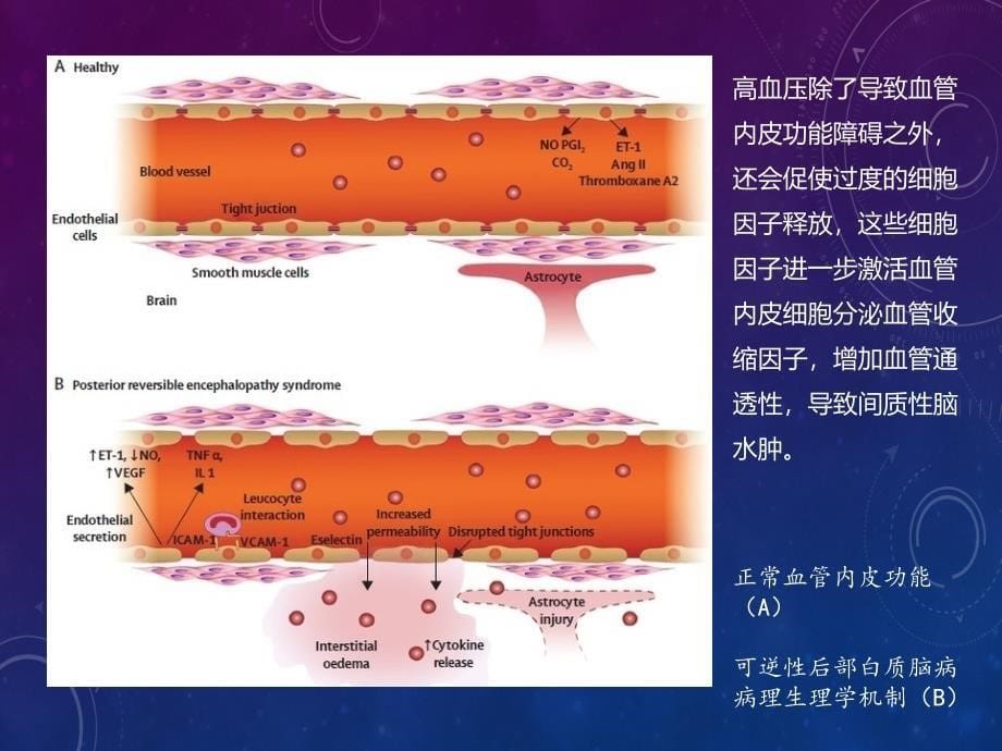 可逆性后部白质脑病.ppt_第5页