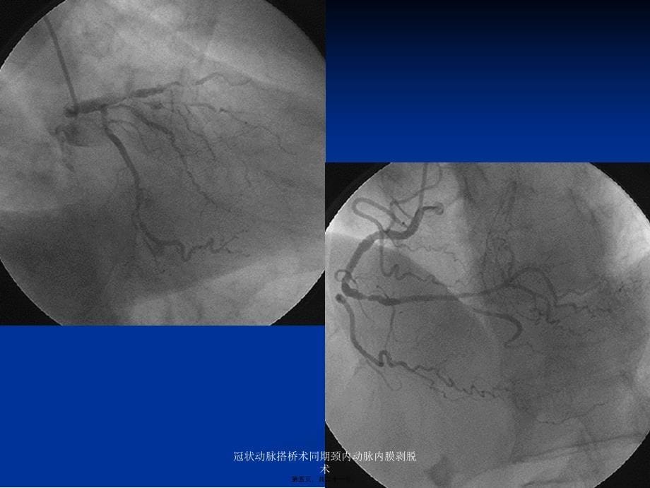 冠状动脉搭桥术同期颈内动脉内膜剥脱术课件_第5页