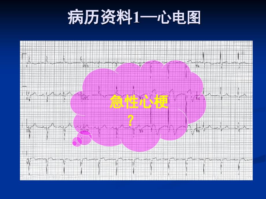 应激性心肌病、Tako-Tsubo章鱼瓶心肌病_第4页