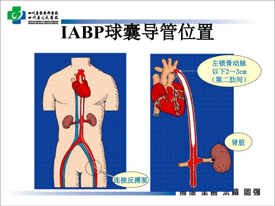 主动脉内球囊反搏在心脏外科围手术期的应用PPT课件_第4页