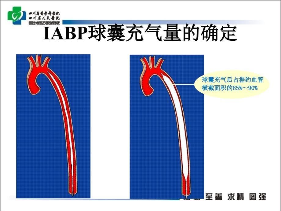 主动脉内球囊反搏在心脏外科围手术期的应用PPT课件_第5页