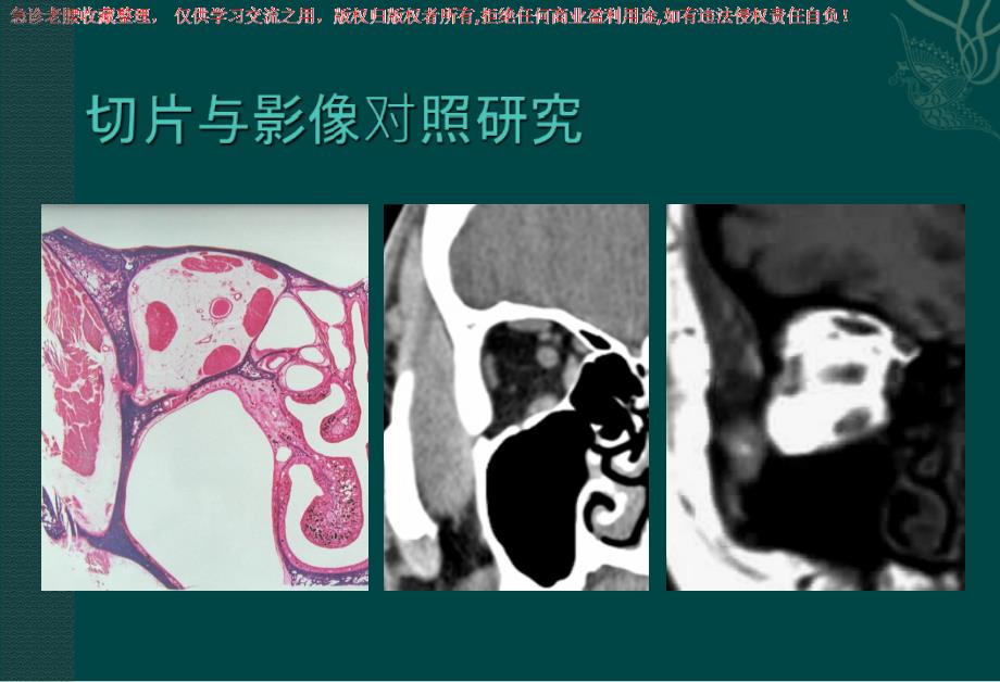 头颈部肿瘤影像诊断与鉴别_第3页