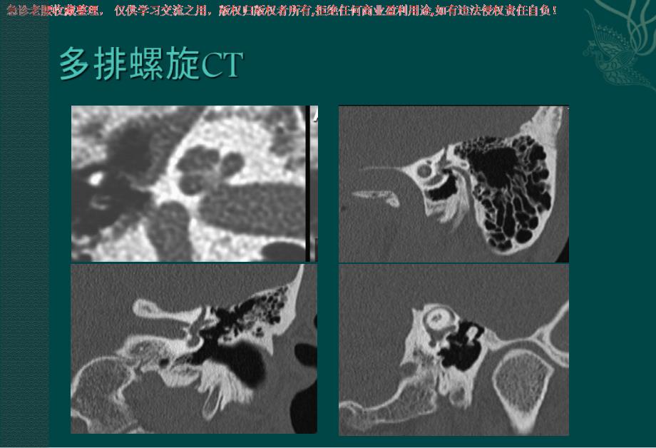 头颈部肿瘤影像诊断与鉴别_第4页